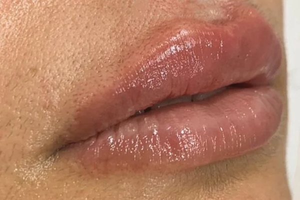 aumentos de labios después