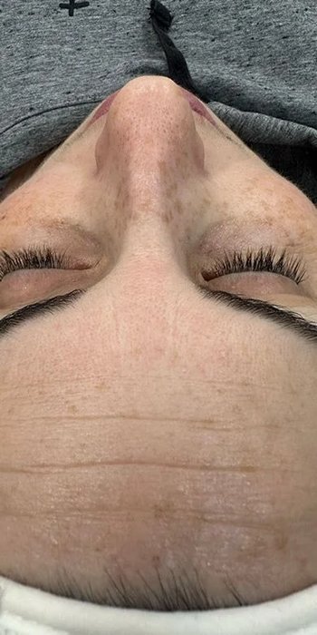 limpieza facial antes