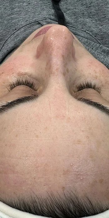 limpieza facial después