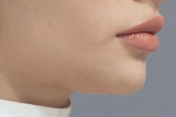 marcación mandibular antes
