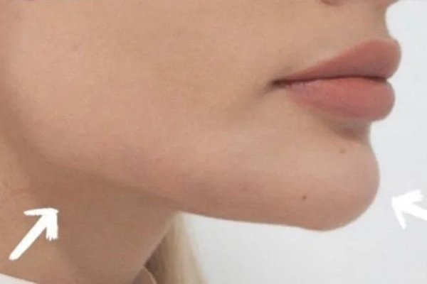 marcación mandibular después