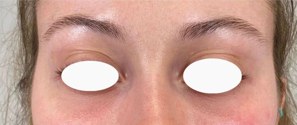 tratamiento antiojeras después