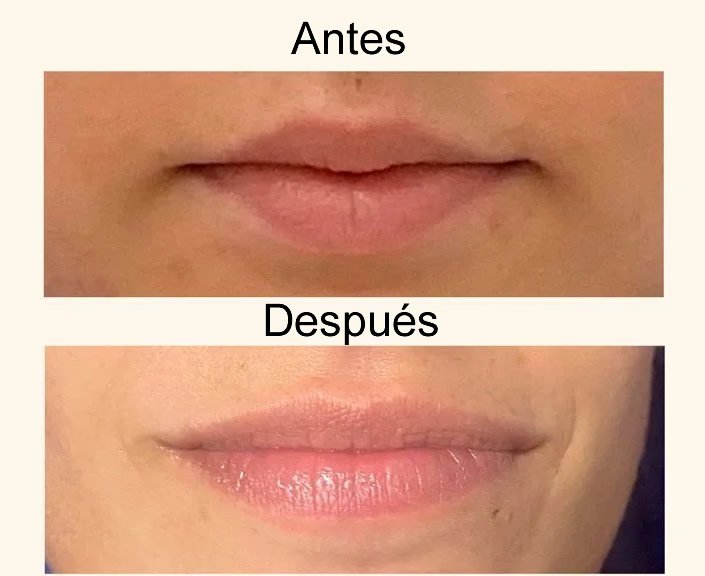 aumento de labios con filler