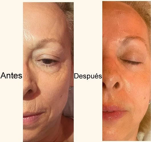 mesoterapia facial total