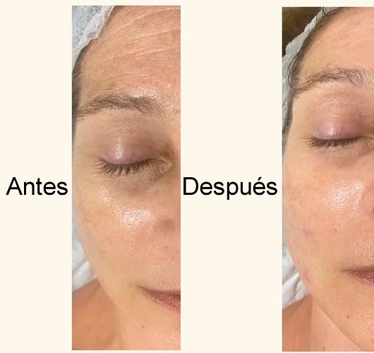 mesoterapia facial