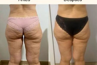 perdida-de-celulitis-culo