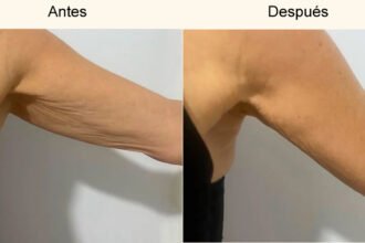 perdida-de-flacidez-en-brazos