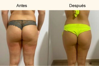 perdida-de-volumen-culo